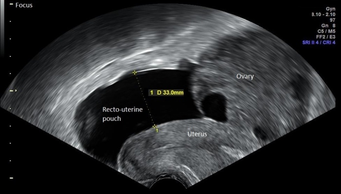 Vaginal Ultrasonography in Sagittal Plane.jpg