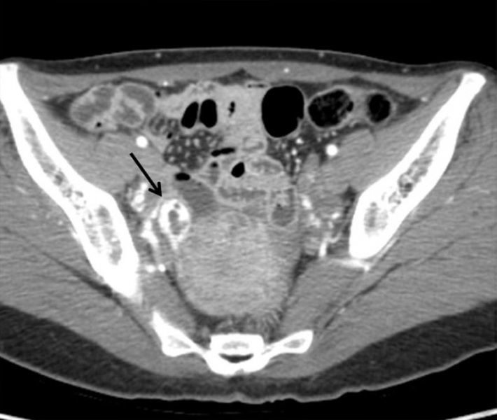 File:Ectopic pregnancy CT 01.jpg