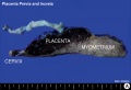 Placenta previa and increta