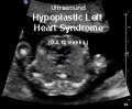 Hypoplastic left heart syndrome movie icon.jpg
