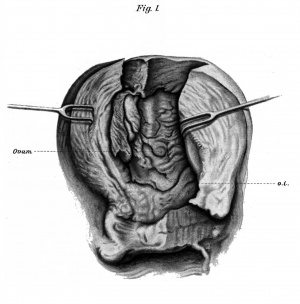 pregnant uterus split up its anterior wall