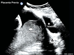 Placenta previa ultrasound 01.jpg