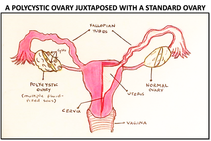 File:Polycystic Ovary juxtaposed with a Standard Ovary.png