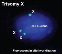 Fluorescent in situ hybridization shows tree copies of the X chromosome in a single cell nucleus.[3]