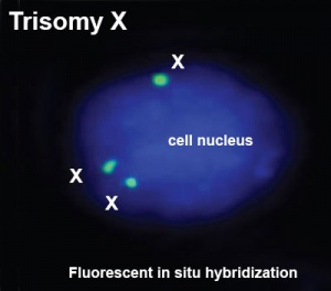 Trisomy X.jpg