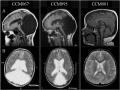 Fig 25 Brain MRIs. Brain imaging of patients with Dandy-Walker malformation