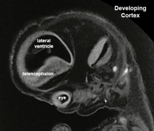 Stage23 MRI S01-cortex.jpg