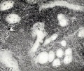 Fig. 177. Villi showing obliteration of vessels by maceration and disintegration. No. 640.