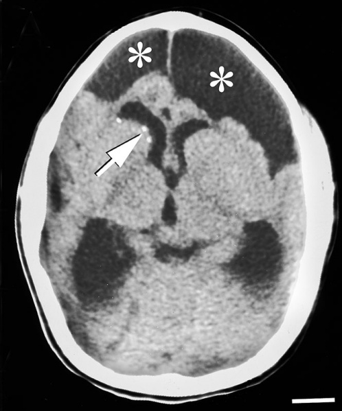 File:Infant lymphocytic choriomeningitis virus CT.jpg
