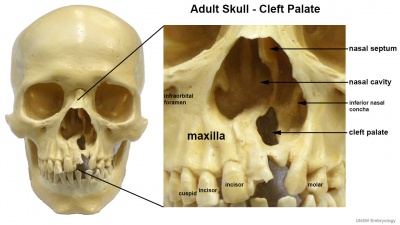 Adult skull cleft palate