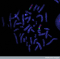 FISH (fluorescence in situ hybridisation) image showing the critical region of Angelman Syndrome on chromosome 15.