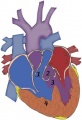 Tetralogy of fallot-the four defects