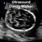 Dandy-Walker ultrasound