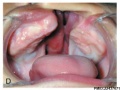 Complete Unilateral cleft lip and palate