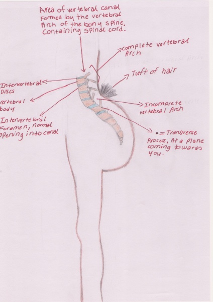 File:Spina bifida occulta.jpg