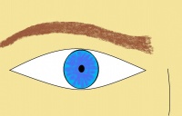 Stellate Iris. This image shows a typical eye of an individual with Williams Syndrome showing the stellate iris.