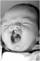 newborn girl with cleft lip and palate Z5018221 Reference, copyright and student template, relevant to project.