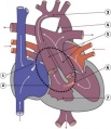 Functional Hypoplastic Left Heart
