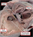 Fig 20 Ventricular Septal Defect Z5059996 Description, Ref, copyright and student template OK, relevant to project page.