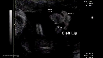 Cleft lip 02.jpg