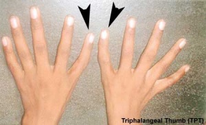 Triphalangeal Thumb