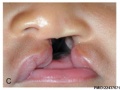 Complete Unilateral cleft lip and palate