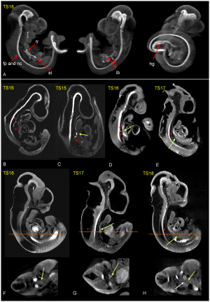 Adriamycin treated mouse shows association of abnormal notochord branching and fore gut abnormality
