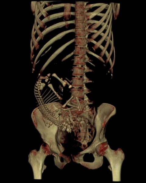 File:Fetus 35 week CT.jpg