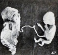 Figs. 42-50. Various forms of cyemata classed as fetus compressus: Nos. 896 (X.55).