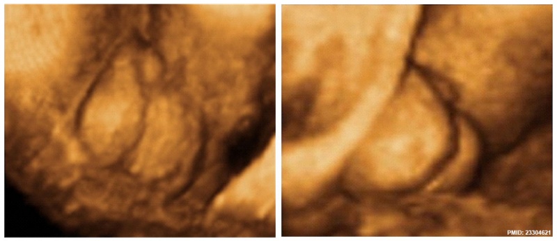Hypospadia 3D ultrasound 01.jpg