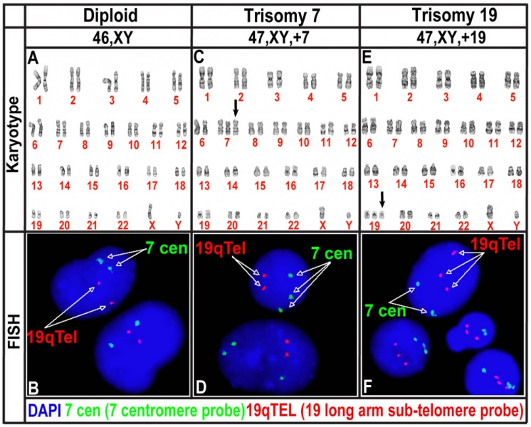 File:Human trisomy chromosome 7 and 19.jpg