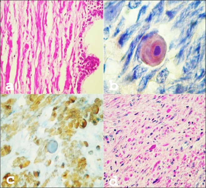 File:Corpora amylacea in prostatic stromal smooth muscle.jpg