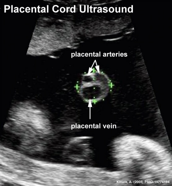 File:Placental cord ultrasound 03.jpg