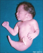 Sirenomelia infant