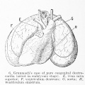 6. Grunmach's case of pure congenital dextrocardia (arrest in embryonic stage). E, vena cava superior; F, ventriculum dextrum; G, aorta; H , ventriculum sinistrum.
