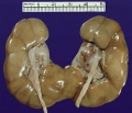 Fig 8 Pathology horseshoe kidney