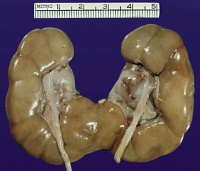 Horseshoe kidney 01.jpg