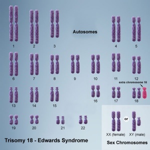 Chromosome- trisomy 18.jpg