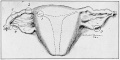 Fig. 5. The Sites of Implantation of the Ovum in Extra-uterine Pregnancy