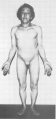 Figure 12: A Thirty-five-year-old woman with Turner syndrome. Note increased carrying angle of arms, broad flat chest and sexual infantilism, but the lack of pronounced neck webbing or peripheral edema.
