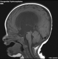 Congenital hydrocephalus (MRI)
