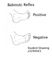 Relevant to group project topic. Meets the student drawn figure criteria. Clearly shows the reflex. Includes student disclaimer and copyright information. Included legend provides information that meets the peer teaching criteria. You could have included some additional information about the normal transient nature of this reflex.