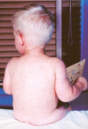 Child with Measles back rash day 3