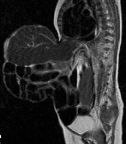 File:Omphalocoele MRI.jpg