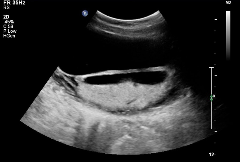 File:US Circumvallate placenta 01.jpg