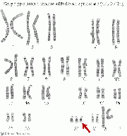 Karyotype Pictures Of Spina Bifida 7