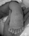 Left foot polydactyly