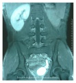 MRI showing renal agenesis