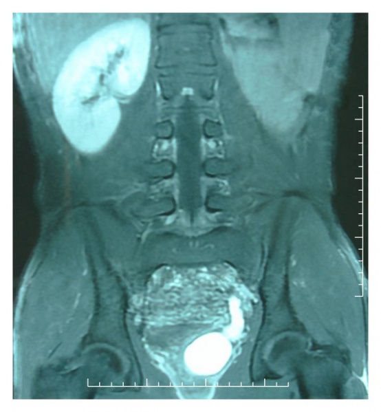 File:MRI renal agenesis .jpg