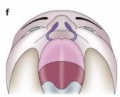 Bilateral cleft lip.jpg